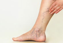 Varicose Vein