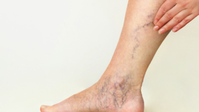 Varicose Vein